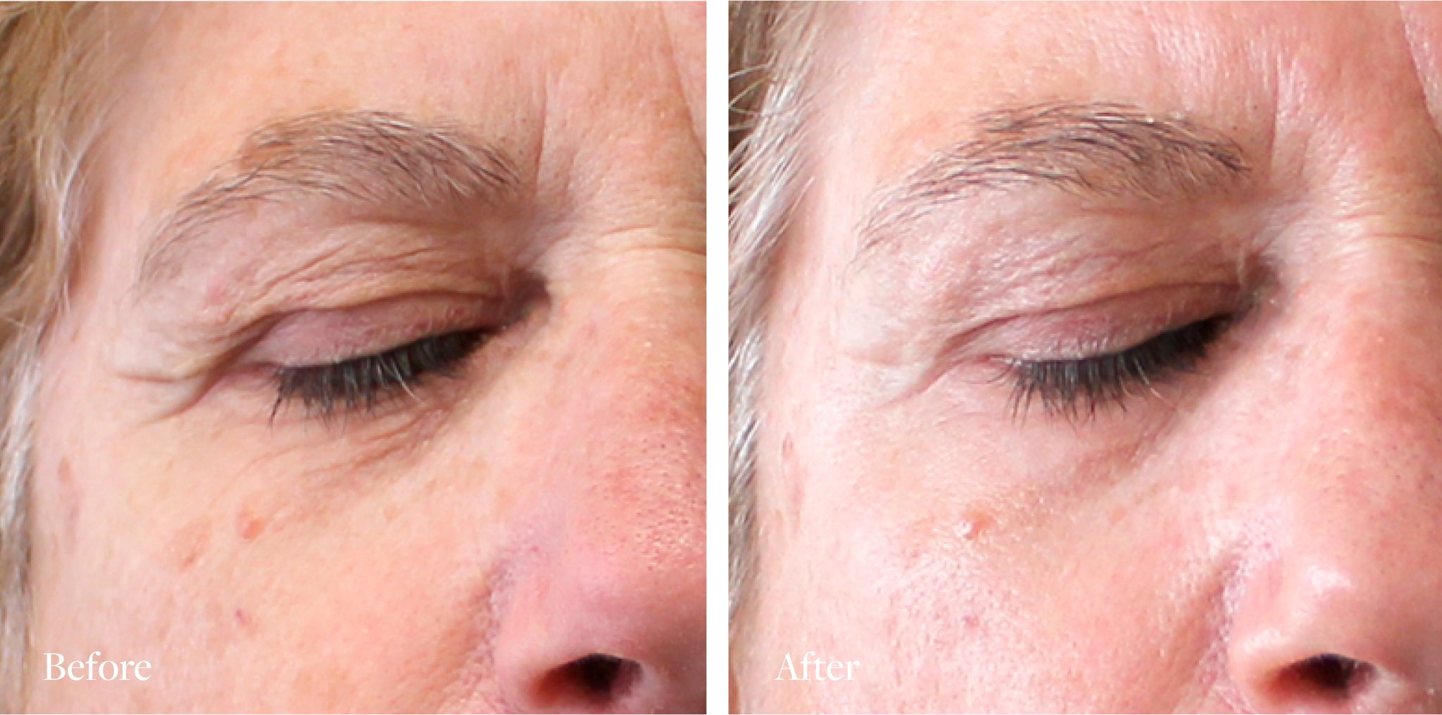 TPRX Peeling Solution, 5x10 ml
