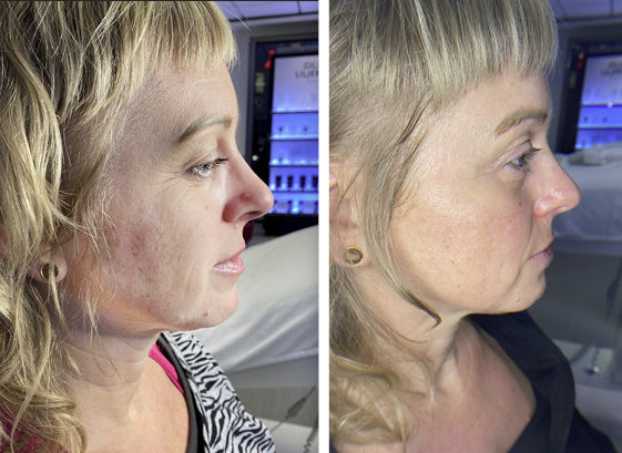 TPRX Peeling Solution, 5x10 ml
