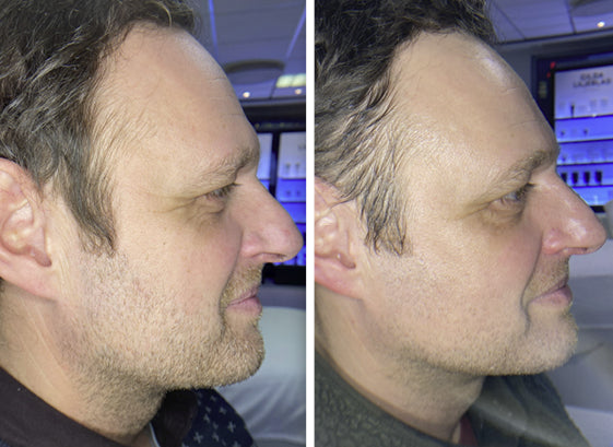 TPRX Peeling Solution, 5x10 ml