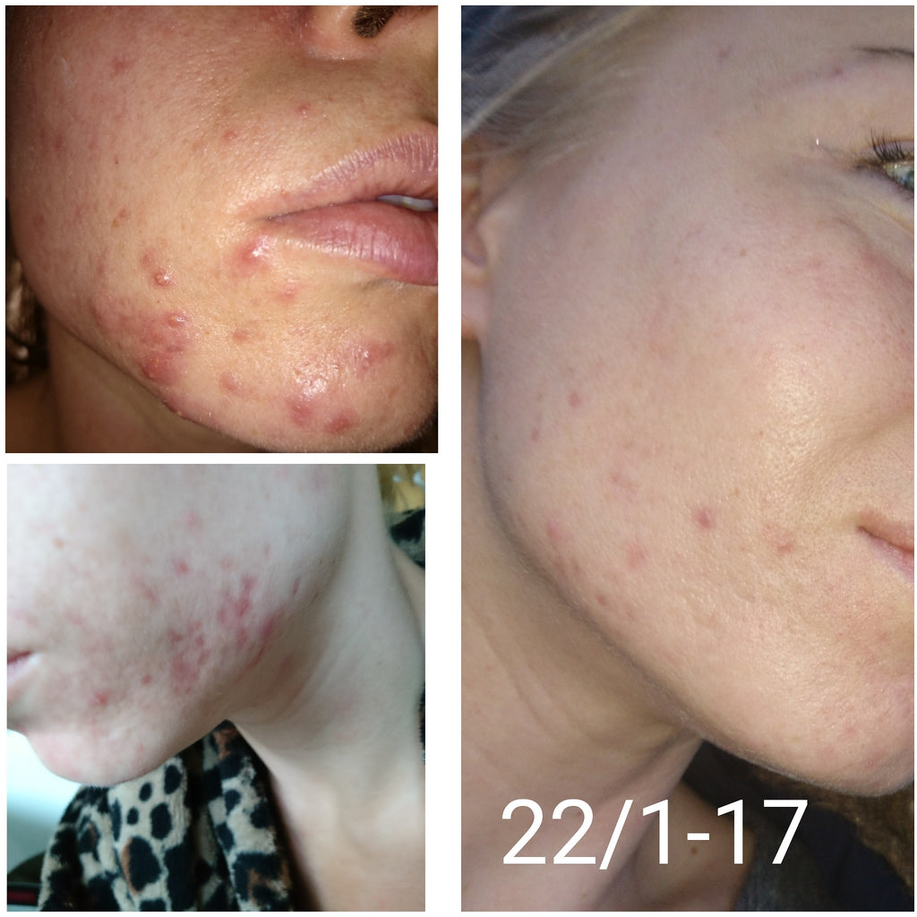 microneedling pen