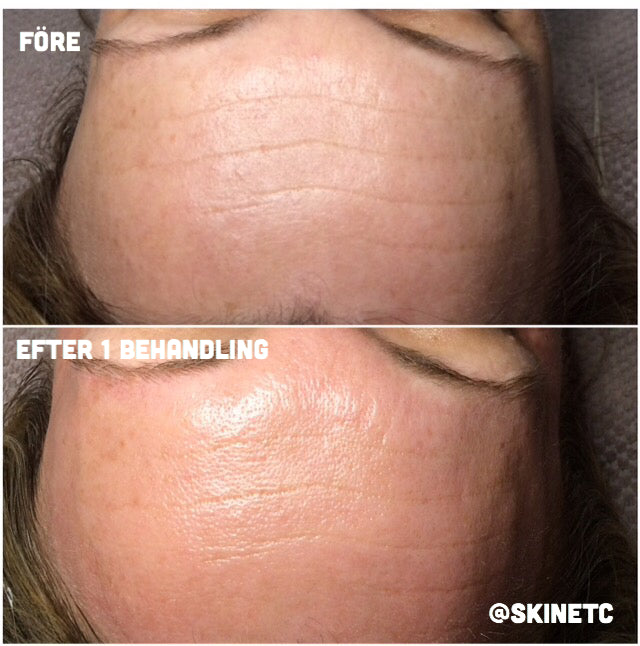 microneedling pen